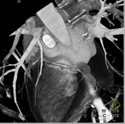 LAD - CTisus CT Scan