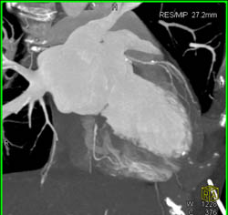 Minimal LAD Plaque - CTisus CT Scan