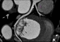 Normal LAD Plaque - CTisus CT Scan