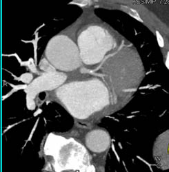 Minimal LAD Plaques - CTisus CT Scan