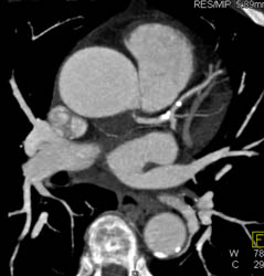 Calcified LAD Plaques in Various Renderings - CTisus CT Scan