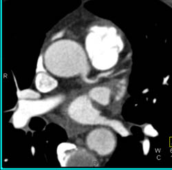 Minimal LAD Disease - CTisus CT Scan