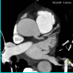 Minimal LAD Disease - CTisus CT Scan