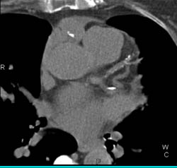 Dilated RCA With Fistulae RCA to Coronary Sinus - CTisus CT Scan