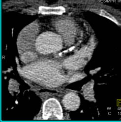 LAD Plaque - CTisus CT Scan