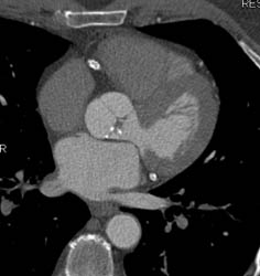 Patent Stent in RCA - CTisus CT Scan