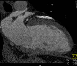 Patent LAD Stent - CTisus CT Scan