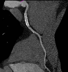 Patent LAD Stent - CTisus CT Scan