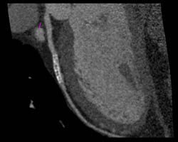 Patent LAD Stent - CTisus CT Scan