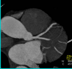 Pseudolesion in Circumflex Coronary Artery - CTisus CT Scan