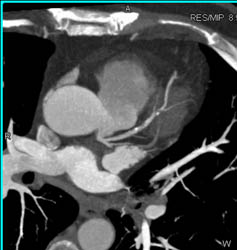 LAD Disease - CTisus CT Scan