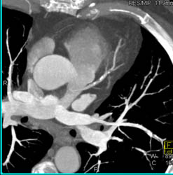 LAD Disease - CTisus CT Scan