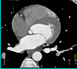 Plaque in RCA - CTisus CT Scan