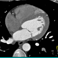 Plaque in RCA - CTisus CT Scan