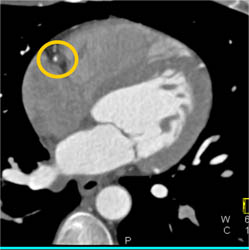 Plaque in RCA - CTisus CT Scan