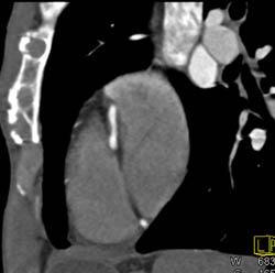 Plaque in RCA - CTisus CT Scan