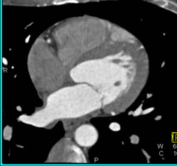 Plaque in RCA - CTisus CT Scan