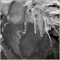 Extensive LAD Plaques - CTisus CT Scan