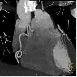 Ectatic RCA - CTisus CT Scan