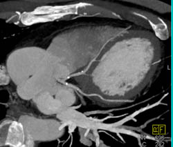 Minimal Plaques in LAD and Circumflex - CTisus CT Scan