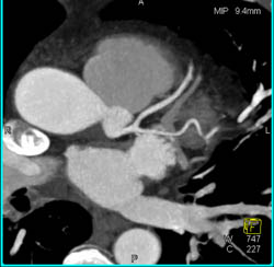 Normal Lca and Circumflex - CTisus CT Scan