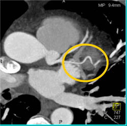 Pseudolesion Due to Poor Rendering - CTisus CT Scan