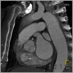 Coarctation of the Aorta - CTisus CT Scan