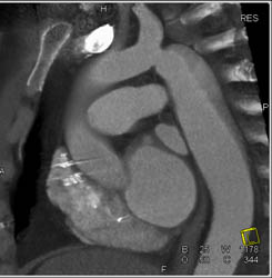 Coarctation of the Aorta - CTisus CT Scan