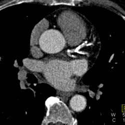 Severe LAD/ Circumflex Calcification - CTisus CT Scan