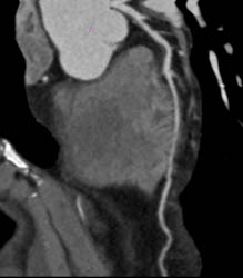 Normal LAD - CTisus CT Scan