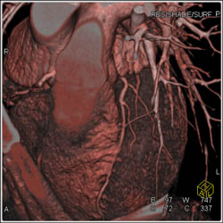 Normal LAD - CTisus CT Scan