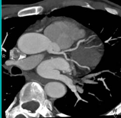 Normal LAD - CTisus CT Scan