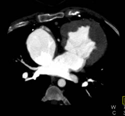 Prominent Right Atrium - CTisus CT Scan