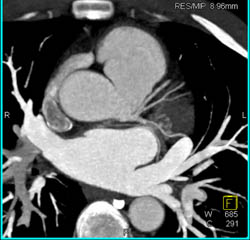 Normal RCA - CTisus CT Scan