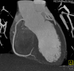 Normal RCA - CTisus CT Scan