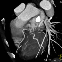 Normal Coronary Tree in 3D - CTisus CT Scan