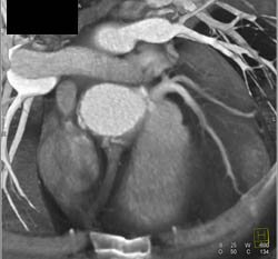 Dilated RCA With Reimplantation - CTisus CT Scan