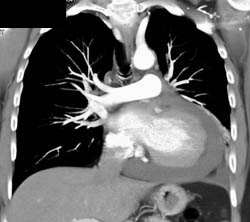 Pericardial Effusion - CTisus CT Scan