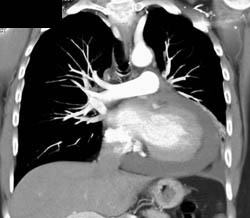 Pericardial Effusion - CTisus CT Scan