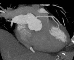 Normal LAD - CTisus CT Scan