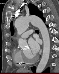 Coarctation of the Aorta With Re-implanted Coronary Artery - CTisus CT Scan