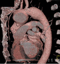 Arch Aneurysm With VRT and MIP - CTisus CT Scan