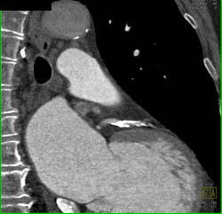 LAD Disease - CTisus CT Scan