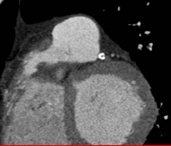 LAD Disease - CTisus CT Scan