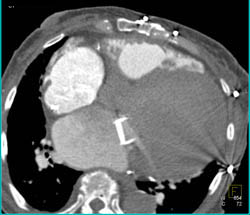 Cardiomegaly With Mitral Valve Replacement and Poor Cardiac Function - CTisus CT Scan