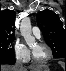 Aortic Valve Replacement (AVR) Replacement - CTisus CT Scan