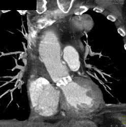 Aortic Valve Replacement (AVR) With 3D and 4D Maps - CTisus CT Scan