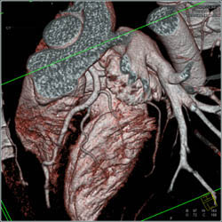 Normal LAD - CTisus CT Scan