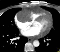 Cardiac Lymphoma Also Involves the Pancreas - CTisus CT Scan