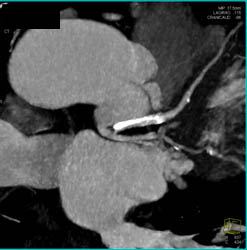 LAD Disease With Calcified Plaque - CTisus CT Scan